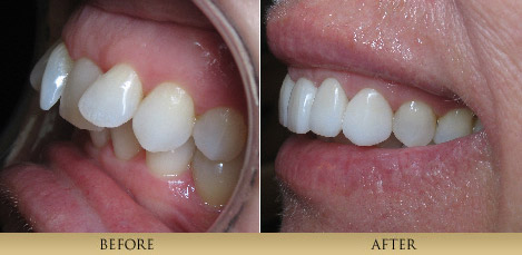 porcelain veneers to correct crooked teeth